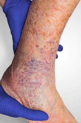 Varicose Veins Leg